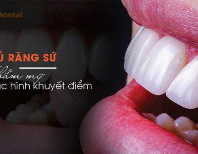 Dán sứ Veneer là gì? Ưu điểm, quy trình và độ bền thực tế tại Nha khoa SV