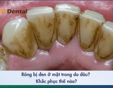 Răng Bị Đen Ở Mặt Trong: Nguyên Nhân, Tác Hại Và Cách Điều Trị Hiệu Quả Tại Nha Khoa SV