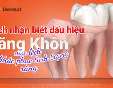 Cách nhận biết răng khôn mọc lệch & phương pháp khắc phục hiệu quả tại Nha Khoa SV