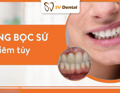 Răng Bọc Sứ Bị Viêm Tủy: Nguyên Nhân, Triệu Chứng Và Cách Điều Trị Hiệu Quả tại NHA KHOA SV 