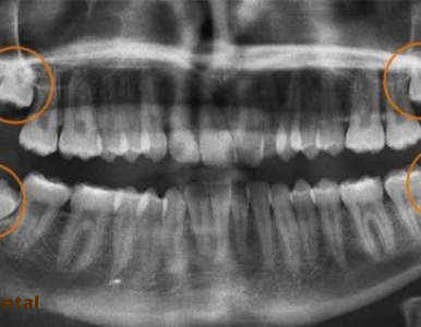 Tìm hiểu về răng khôn (răng số 8): Khi nào nên nhổ để tránh biến chứng? tại NHA KHOA SV 