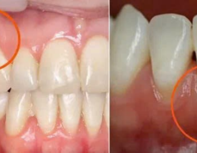 Điều trị tụt nướu (tụt lợi) – Viêm nha chu an toàn, hiệu quả tại Nha Khoa SV