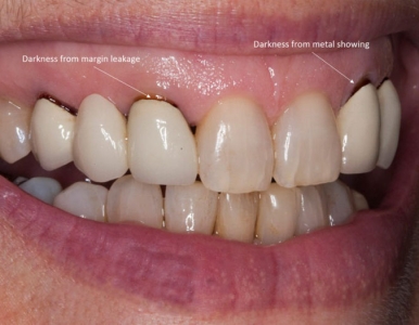 Bọc răng sứ bị đen chân răng: Nguyên nhân và cách khắc phục 