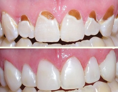 Trám răng là gì? Dịch vụ trám răng uy tín tại Nha khoa SV quận 3