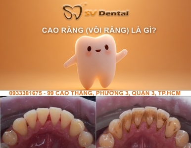 Cạo Vôi Răng (Cạo Cao Răng) – Tại Sao Cần Thực Hiện Định Kỳ?
