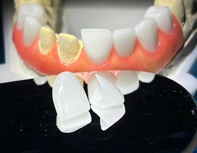 Bọc răng sứ thẩm mỹ