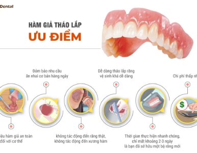 Ưu Điểm Của Hàm Giả Tháo Lắp – Giải Pháp Phục Hình Răng Tiết Kiệm, Hiệu Quả