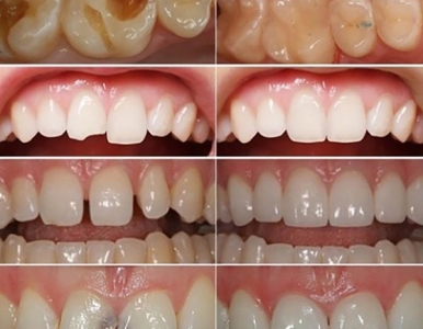 Trám răng  composite là gì? Nha khoa SV quận 3 