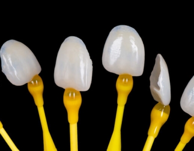 Mặt dán sứ Veneer Lisi- Nha khoa SV quận 3: 0933381675