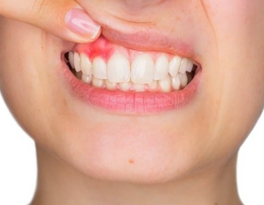 Bệnh viêm nha chu là gì? Nguyên nhân và phương pháp điều trị