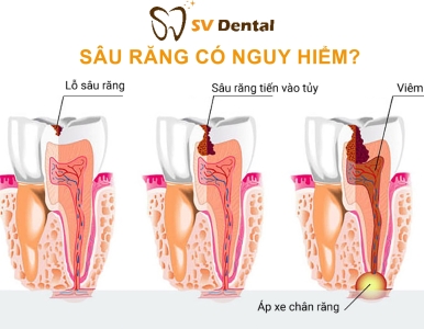 Răng sâu có nguy hiểm không?