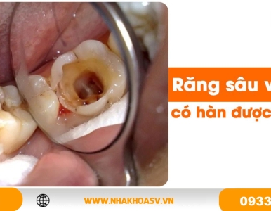 Răng sâu vào tủy có hàn được không?