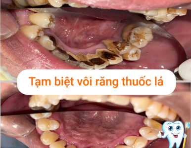 Tạm biệt vôi răng thuốc lá – Giải pháp làm sạch răng hiệu quả cho người hút thuốc