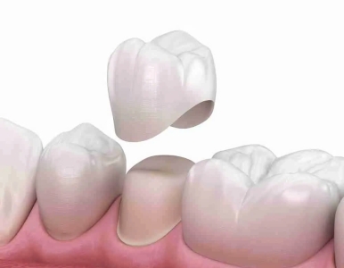 Bọc răng sứ là gì? có rủi ro không và thực hiện thế nào?