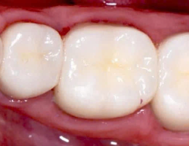 Trám răng ở đâu uy tín Nha Khoa Quận 3 