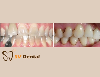 Trám Răng Sâu: Giải Pháp Bảo Vệ Nụ Cười Khỏe Mạnh Toàn Diện