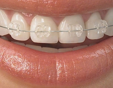 Niềng Răng Mắc Cài  