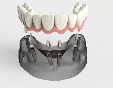Cấy ghép implant tại NHA KHOA SV ? có nên cấy ghép không  ? nha khoa cấy ghép implant uy tín . 