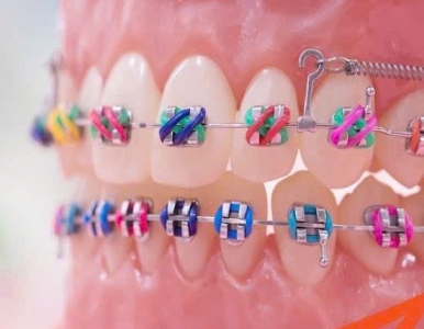 Niềng răng là gì? Địa chỉ niềng răng uy tín tại quận 3- Nha khoa SV