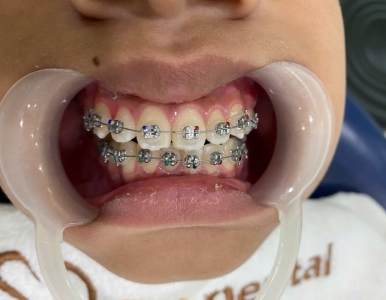 Vì sao nên chọn niềng răng chỉnh nha? Nha khoa SV quận 3 