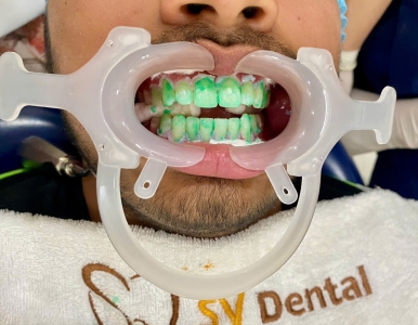 Xóa đốm trắng trên răng bằng Icon DMG: Nha khoa SV quận 3 