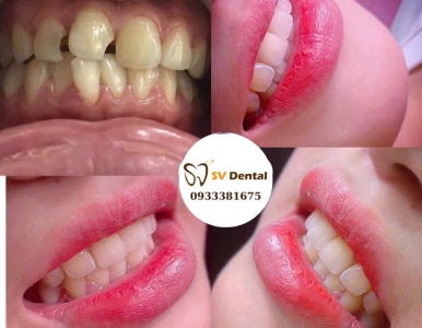 Răng sứ có hôi miệng không ? giáp đáp từ bác sĩ NHA KHOA SV, quận 3 