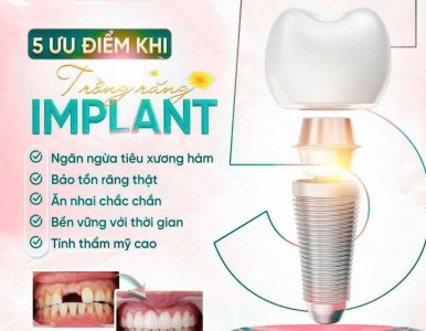 ⭐ 5 ưu điểm vượt trội khi trồng răng Implant bạn không nên bỏ qua