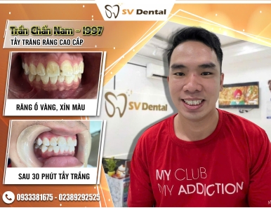 Tẩy trắng răng uy tín TPHCM – Lấy lại nụ cười trắng sáng tự tin