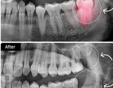 Nhổ  răng khôn có đau không ? giải đáp chi tiết từ BS NHA KHOA SV