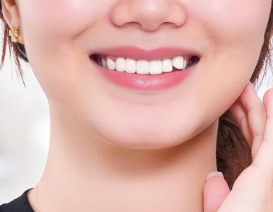 Răng sâu có làm thẩm mỹ sứ Veneer được không? – Ưu đãi 10% - 50% tại Nha khoa SV