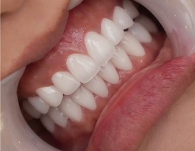 Răng sứ cao cấp giá chỉ 3.000.000/răng  tại NHA KHOA SV , Quận 3 