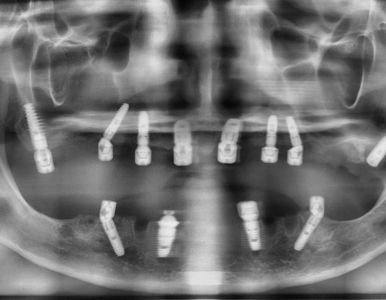 Cấy ghép implant all on 6 giải pháp bền vừng cho răng toàn hàm tại NHA KHOA SV, Phường Bàn Cờ, Tp. Hồ Chí Minh 