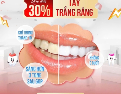Ưu đãi  30% tẩy trắng răng tháng 10- sáng hơn 3 tone sau khi tẩy trắng răng tại NHA KHOA SV 