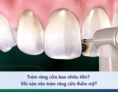 Trám Răng Cửa Bao Nhiêu Tiền 2025? Bảng Giá Trám Răng Cửa Thẩm Mỹ Tại Nha Khoa SV