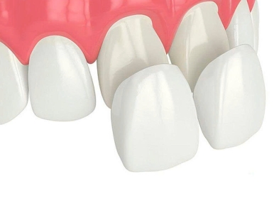 Chi phí bọc răng sứ 2 răng cửa bao nhiêu? Có đau không? Bọc 2 răng cửa tại Nha Khoa SV