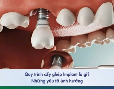 Quy Trình Cấy Ghép Implant Là Gì? Các Yếu Tố Ảnh Hưởng Đến Trồng Răng Implant tại NHA KHOA SV