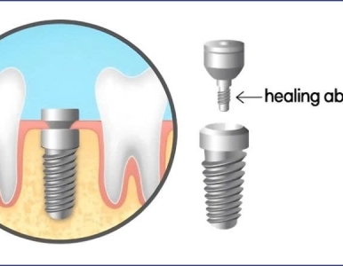 Cấy ghép Implant mất 1 răng – Giải pháp phục hồi răng tối ưu và bền vững tại NHA KHOA SV 