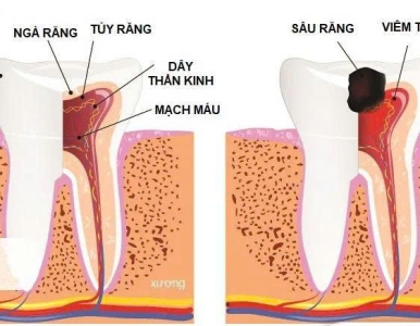 Điều trị tủy răng là gì? Khi nào cần chữa tủy để giữ răng thật? | Nha Khoa SV