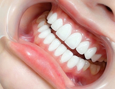 Dán Sứ Veneer Là Gì? Làm Răng Đẹp Tự Nhiên Tại Nha Khoa SV Quận 3