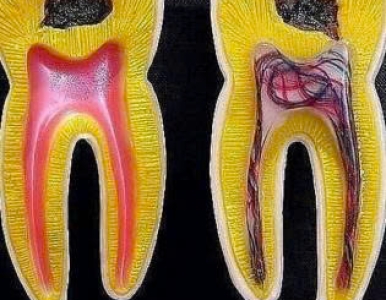 Cách xử lý khi ngà răng bị hư – Tư vấn chuyên môn từ bác sĩ Nha Khoa SV