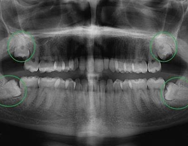 Răng khôn mọc lệch: Dấu hiệu, biến chứng và khi nào cần nhổ an toàn?