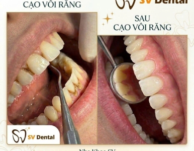 Bao lâu nên cạo vôi răng? Tần suất chuẩn giúp ngừa hôi miệng và viêm nướu