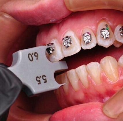 Niềng răng thẩm mỹ 
