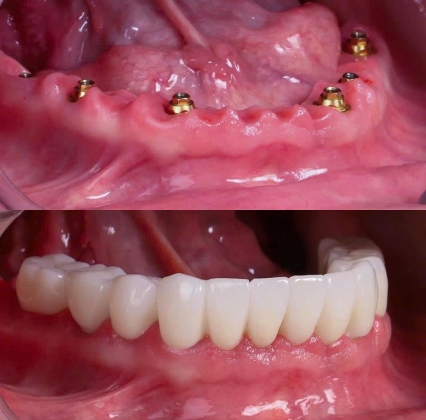 Cấy ghép Implant 