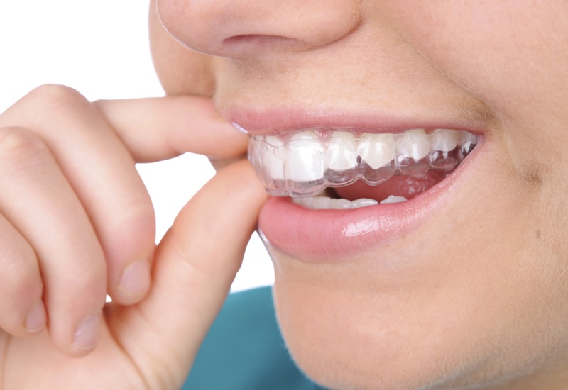 Tẩy trắng răng bằng cách đeo máng chứa chất tẩy tại Nha khoa SV quận 3