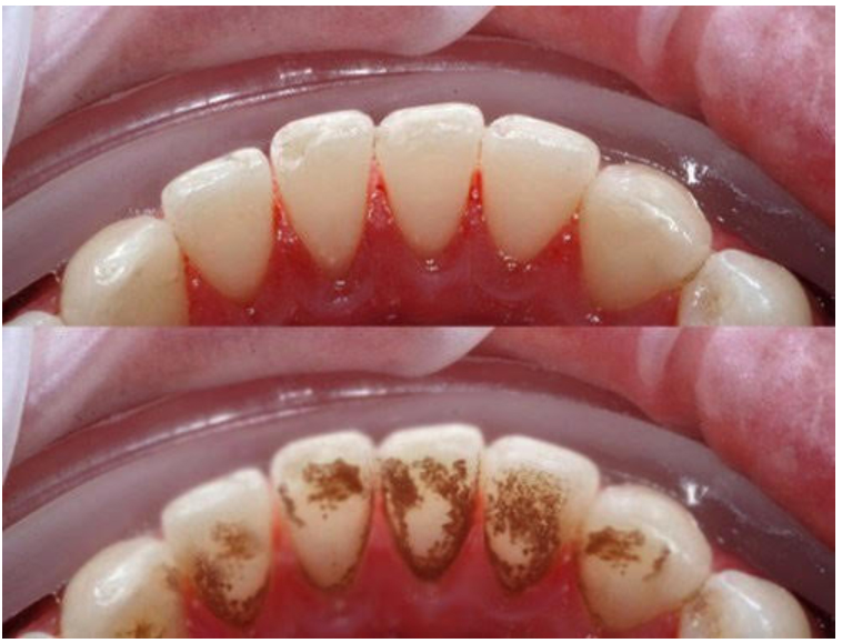 Hình ảnh trước và sau khi cạo vôi răng tại Nha khoa SV quận 3