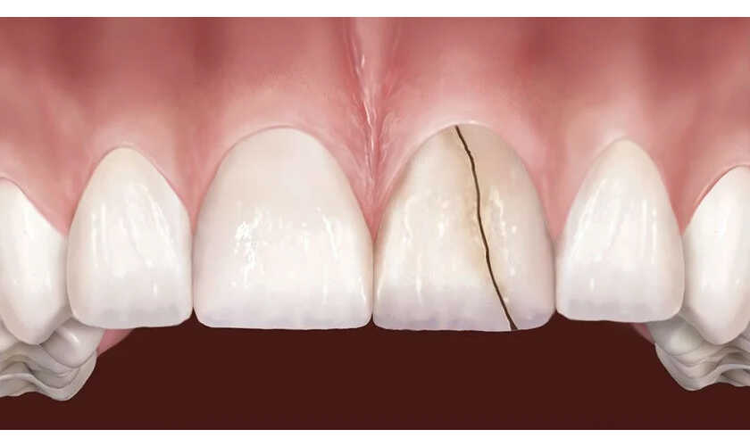 Hình ảnh răng bị nứt nên làm thẩm mỹ răng sứ Lava Esthetic
