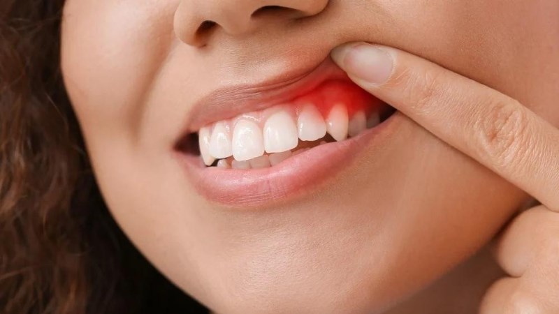 Dấu hiệu nhận biết viêm nướu là đau và sưng tấy tại khu vực nướu