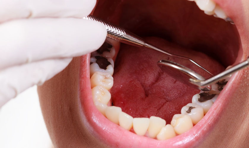 Dịch vụ nhổ răng sâu tại Nha khoa SV quận 3