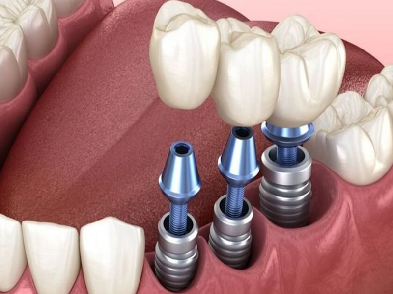 Hình ảnh dịch vụ bọc răng sứ implant của nha khoa SV tại quận 3 